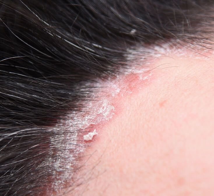 Scalp