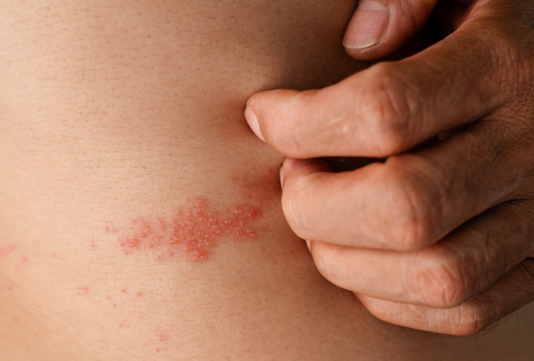 bacterial-skin-rash