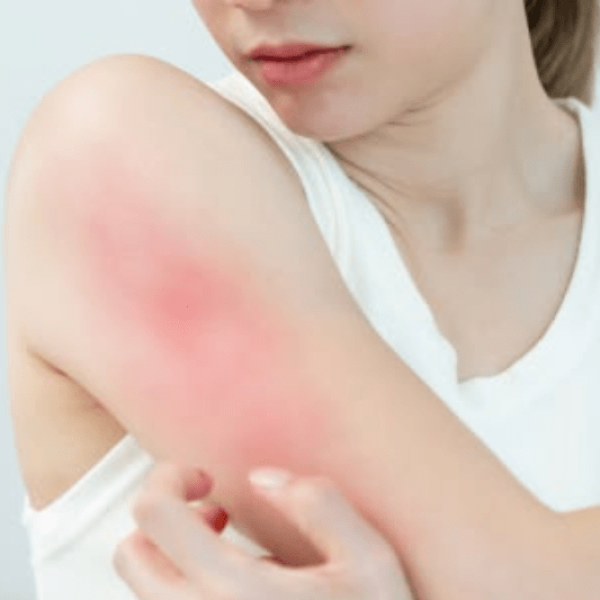 What is Psoriasis? Causes, Symptoms & Natural Treatment