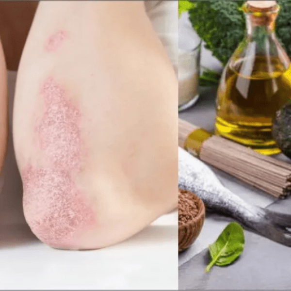 Best Diet for Psoriasis Patients