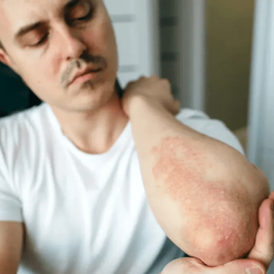 How Long Does Psoriasis Treatment Take?