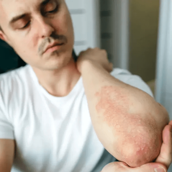 How Long Does Psoriasis Treatment Take?